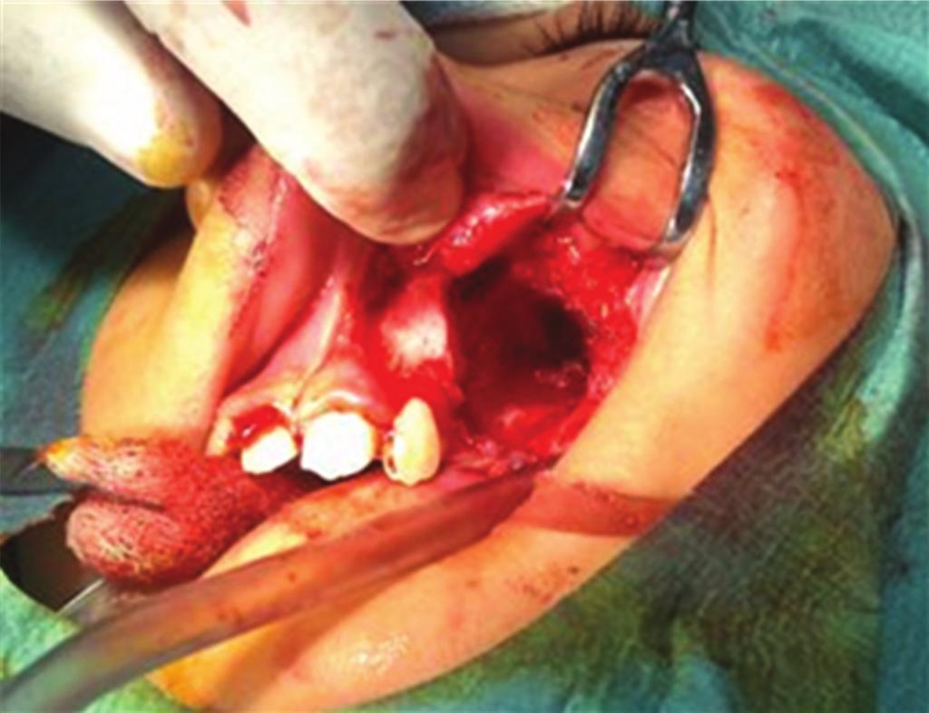 However in cases where the canine is involved, the eruption of the maxillary canine is significantly related to the small size of the cyst and the patient s age [2].
