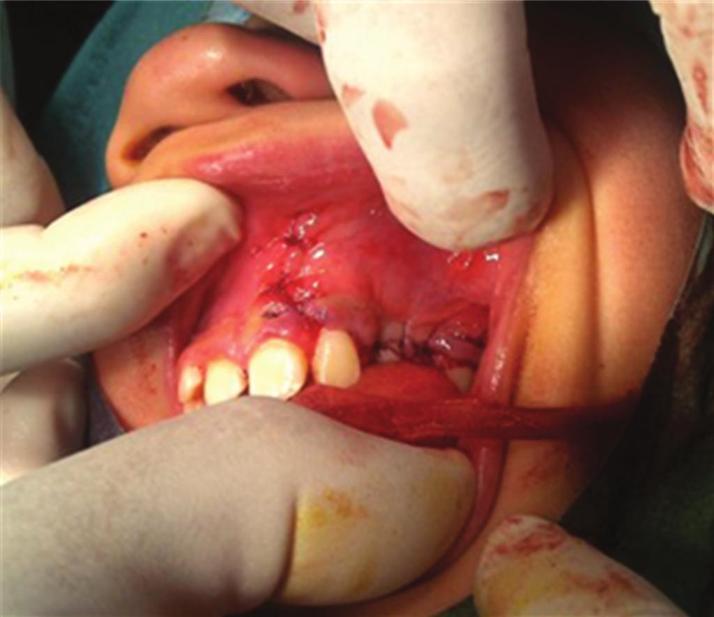 4 Case Reports in Dentistry Figure 12: Histological slide. Figure 10: Primary closure done. Figure 11: Biopsy specimen.