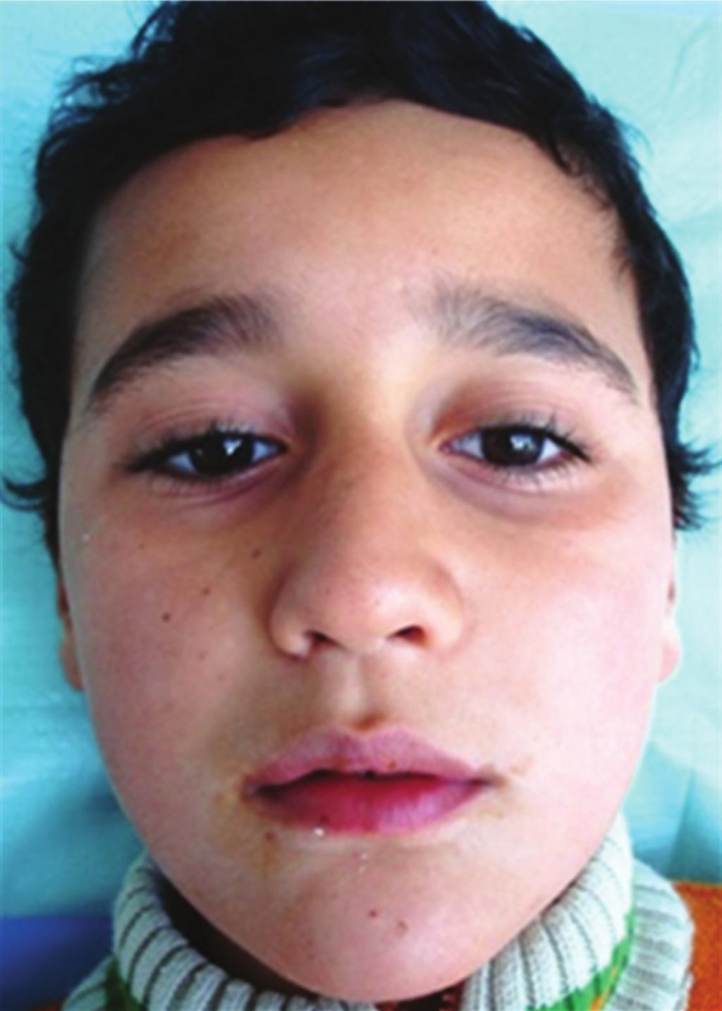 Case Reports in Dentistry 5 (a) (b) Figure 13: Postoperative frontal view and lateral view after 2 years. 5. Conclusion Our patient presented with a painless left facial swelling.
