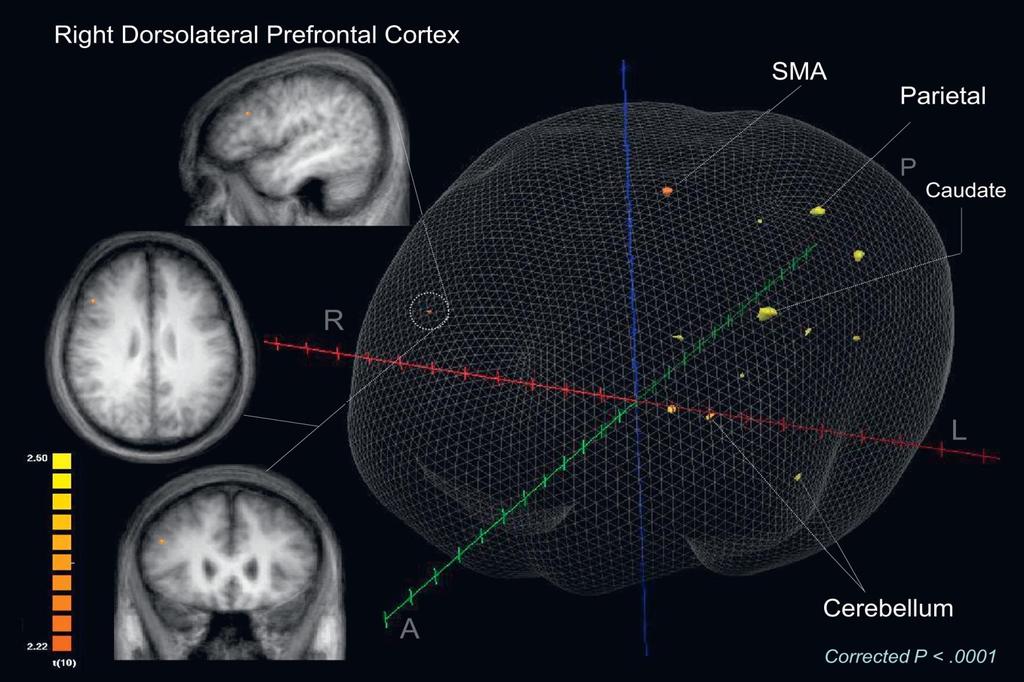 fmri of Atomoxetine: MSIT shows activation of dorsolateral prefrontal, parietal,