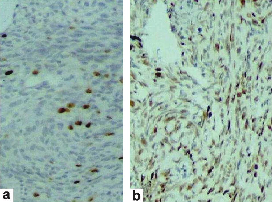 brain parenchyma (arrow) (H and E, 320); b: Higher magnification showing highly atypical cells with increased nucleocytoplasmic ratio (H and E, 3100); c: Large number of tumor cell nuclei showing