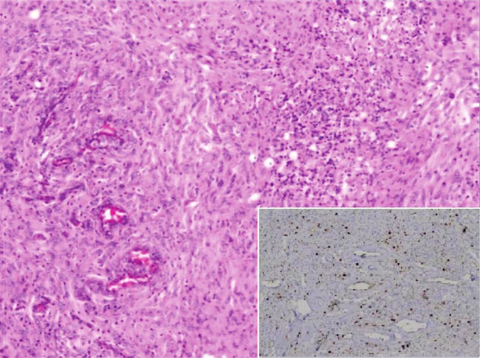 meningioma a: Nuclear positivity seen in many tumor cells signifying high proliferative index (Ki-67 immunostain, 3100); b: High nuclear positivity in tumor cells (p53 immunostain, 3100) Figure 4: