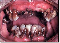 METH TEETH Symptoms Dry Mouth