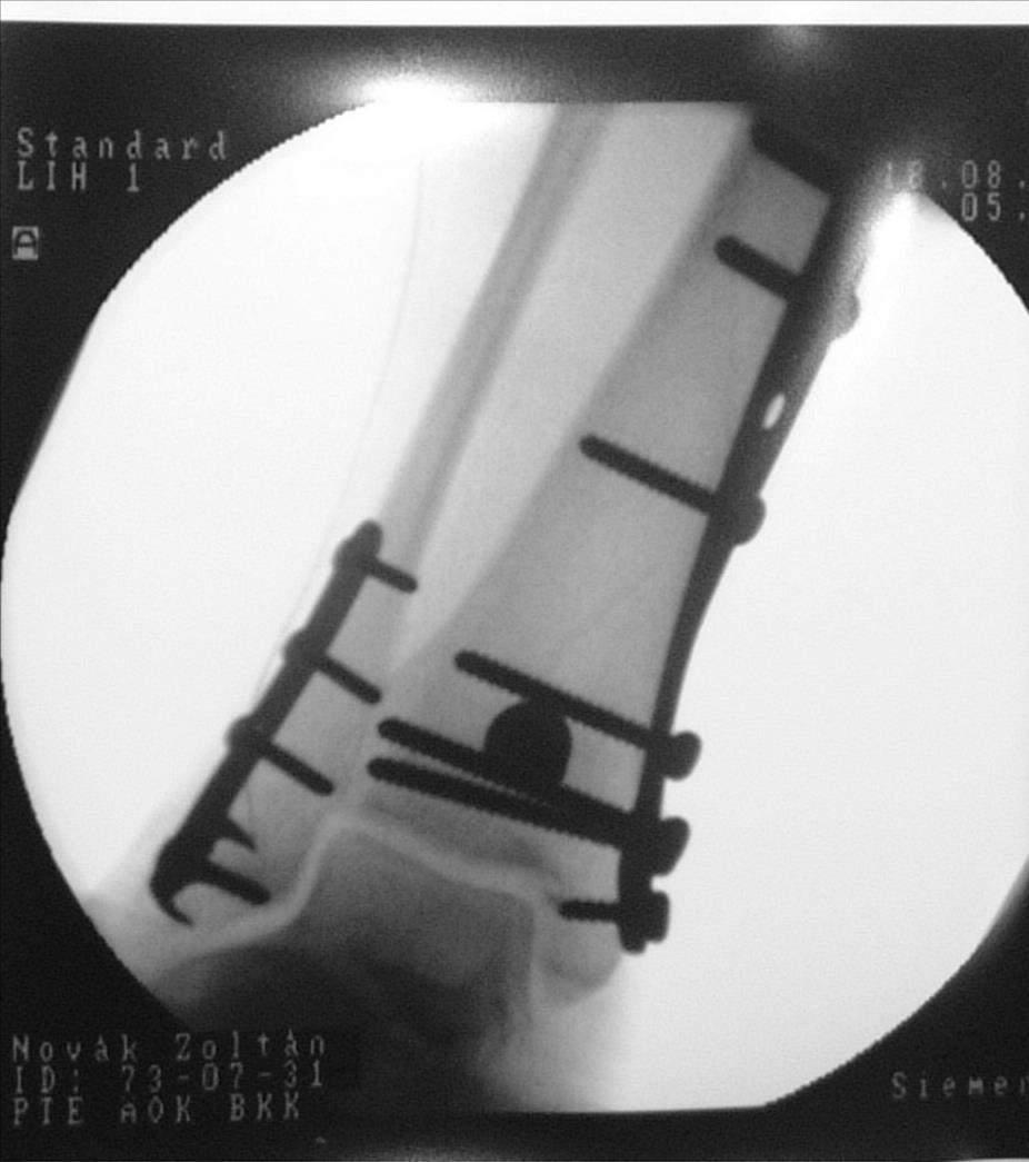 Pylon fracture Tibia