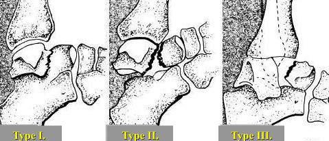 TALUS FRACTURES Fracture Pattern 1. Talar neck fractures 2. Talar body fractures 3. Fractures of posterior, medial or lateral process of talus 4.