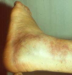 HINDFOOT FRACTURES: CALCANUES