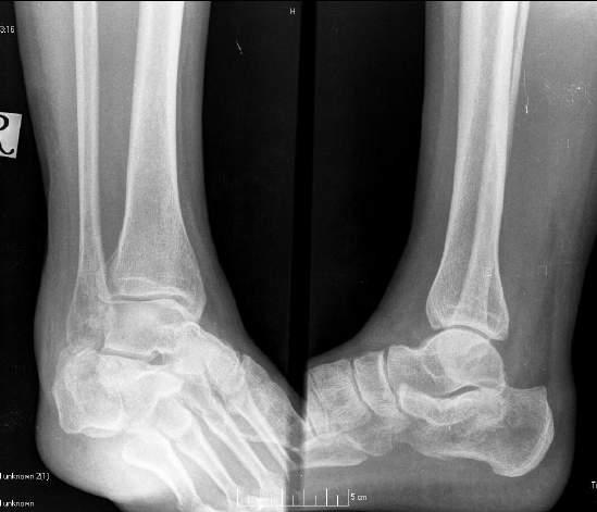 HINDFOOT FRACTURES: CALCANUES Anatomy &