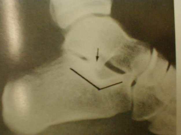 Conventional X-rays: lateral + Broden-views 3.