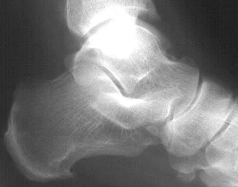 HINDFOOT FRACTURES: CALCANUES Treatment 1.