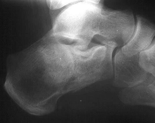 HINDFOOT FRACTURES: