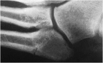 5 th METATARSAL FRACTURES 5 th MT Metaphysis/Diaphysis Jxn Screw fixation OR NWB short-leg cast