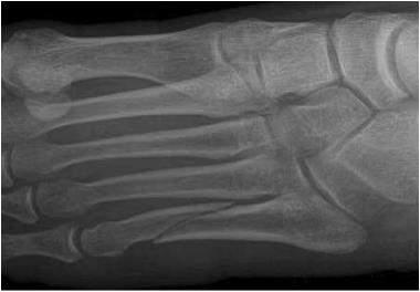 5 th METATARSAL FRACTURES 5 th MT Shaft Fracture Cast fixation or hard-sole shoe,