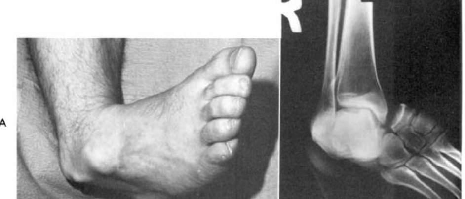 SUBTALAR DISLOCATION Description & Classification The calcaneus, cuboid, navicular, and all of the forefoot become displaced