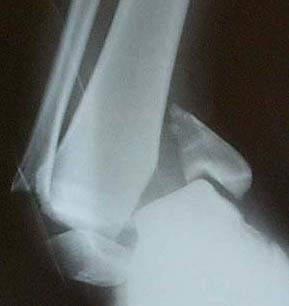 ANKLE FRACTURES