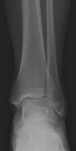 ANKLE FRACTURES I.