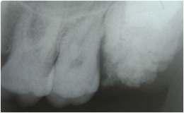 Patient's clinical findings and radiographs were scrutinized and the following data were recorded: age, sex, number of supernumerary teeth, localization of supernumerary teeth, and their associated