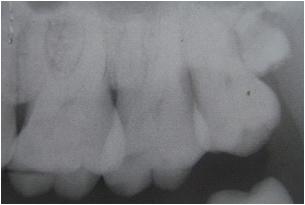 Figure 4: An upper left posterior intraoral periapical radiograph showing distomolar Figure 5: Palatally erupted mesiodens causing crowding of upper anterior teeth Table - 3 Supernumerary