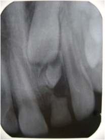 97%) reported with impacted adjacent permanent tooth (Fig6) where as 19 patients (23%) were completely asymptomatic.