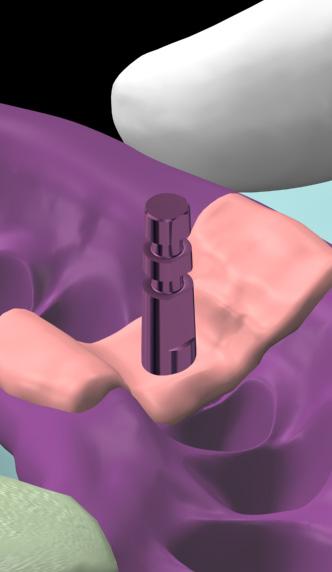 Clinical & Laboratory Procedures for Contoured Abutments Orienting