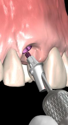 for abutment placement, margin finessing, impressing and placement