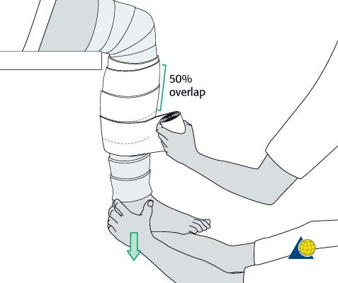 Cast Application- Treatment Under Analgesia or Spinal or General Leg Hanging of table with knee flexed ( Relax Gastrocs and allows traction by Gravity)