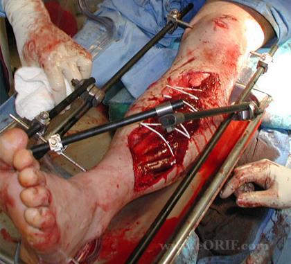 External fixation- Indications Open fractures Fractures with bone loss Nonunion Malunion Infected