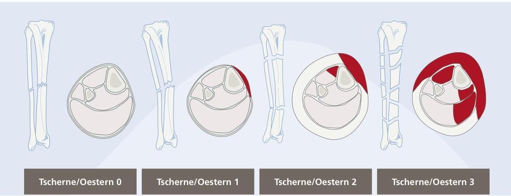 Tschern classification of soft tissues Grade-0 Minimum soft tissue injury Simple # pattern Grade-1 Superficial Abrasion Mild to moderate # pattern