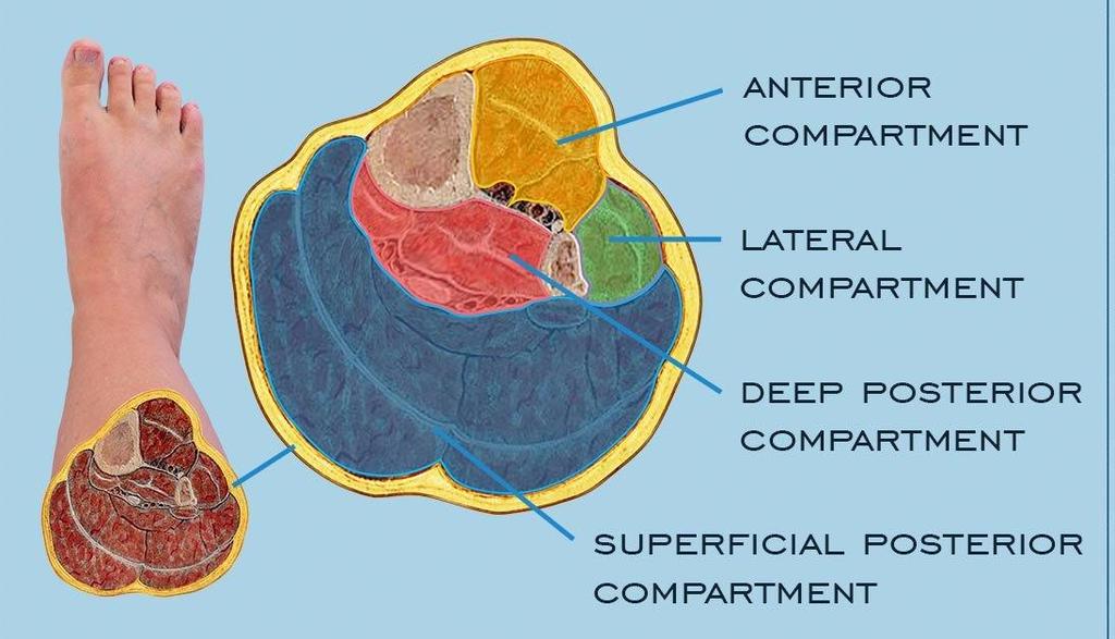 Compartmental syndrome Anterior compartment very common Deep Posterior second