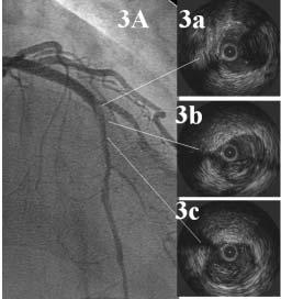 Both guidewires and IVUS catheters pass near to the center of the vessel when crossing a true lumen, but when crossing a false lumen, the IVUS catheter will pass along the lumen s outer rim of