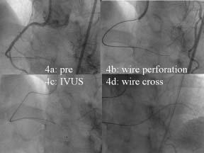 from the feel of the guidewire, but this largely depends on operator experience. IVUS can usually help you identify the CTO ostium or entrance if there are any side branches nearby.