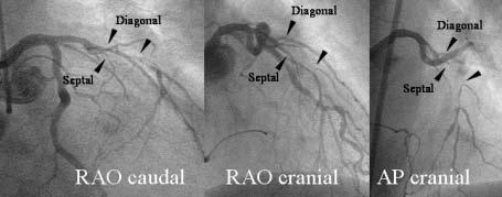 occluded vessel, while 5C is located at the atrial side of the occluded vessel.
