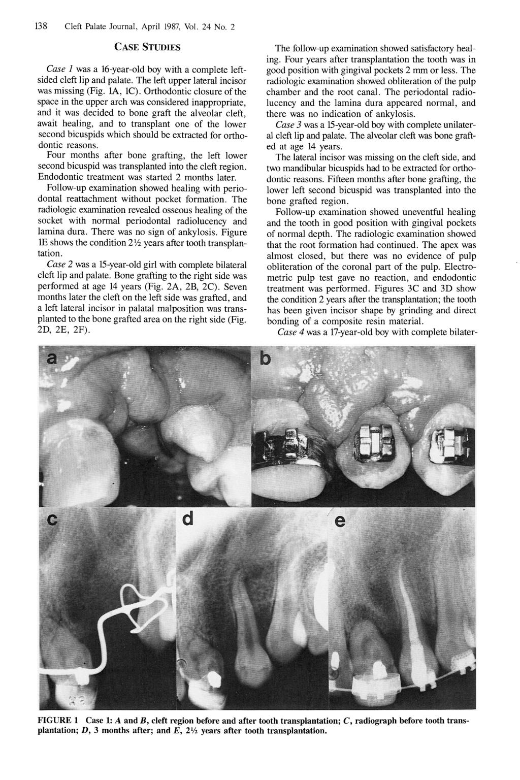138 Cleft Palate Journal, April 1987, Vol. 24 No. 2 CASE STUDIES Case 1 was a 16-year-old boy with a complete leftsided cleft lip and palate. The left upper lateral incisor was missing (Fig. 1A, 1C).