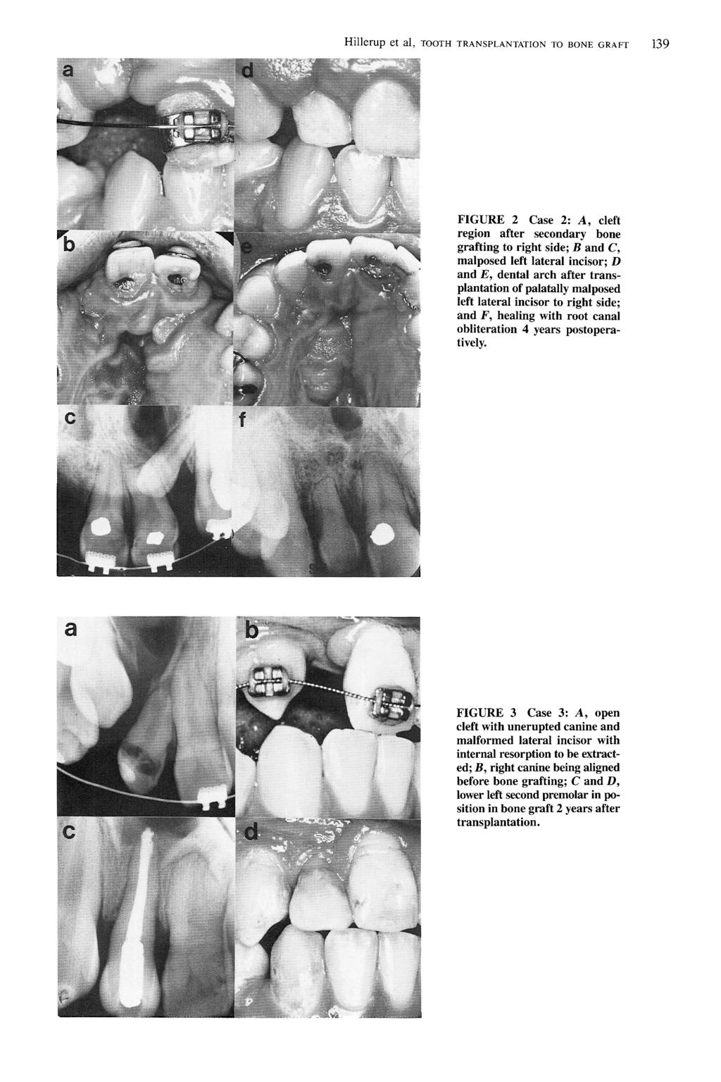 Hillerup et al, TOOTH TRANSPLANTATION TO BONE GRAFT FIGURE 2 Case 2; A, cleft region after secondary bone grafting to right side; B and C, malposed left lateral incisor; D and E, dental arch after
