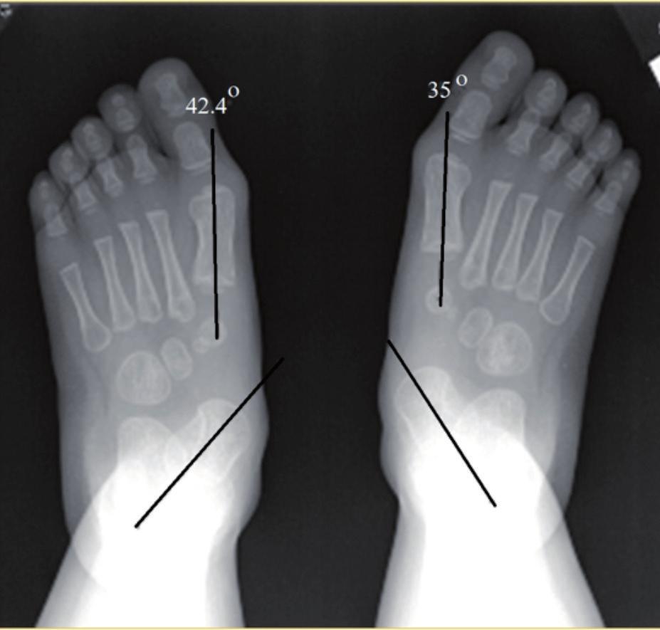 the medial longitudinal arch in children with flexible pes planus 739 Fig. 2. Standing anteroposterior view of both feet showing the radiographic measurement of the APTFM angle.