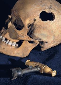 Prescientific Psychology Trephination/Trepanation surgery in which a hole is drilled or scraped
