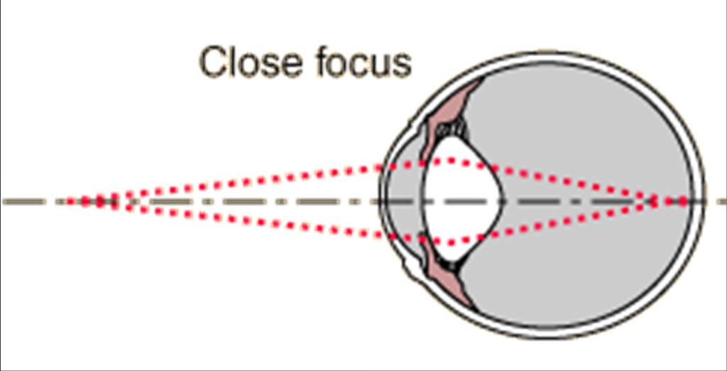 Accommodation: The process by which the eye s lens