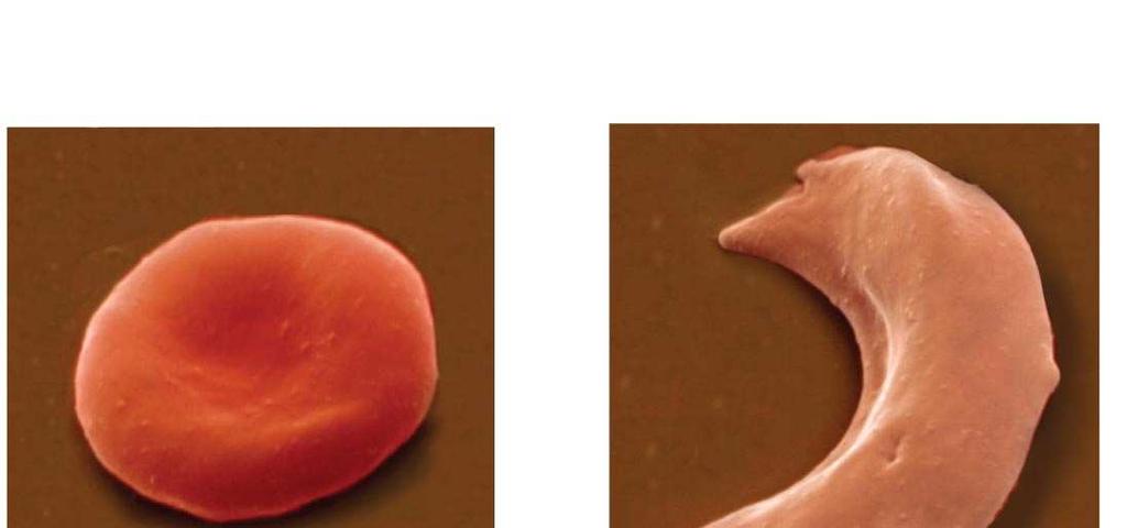 Fig. 5-22c 10 µm 10 µm Normal red blood cells are full of individual hemoglobin molecules,
