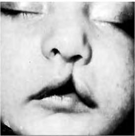 Unilateral cleft lip: result from failure of the maxillary