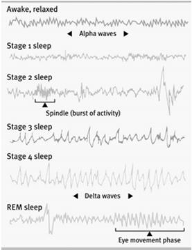 Sleep Disorders Children are most prone to: Dreams Night terrors: The sudden arousal from sleep with intense fear accompanied by physiological reactions (e.g., rapid heart rate, perspiration) which occur during Stage 4 sleep.