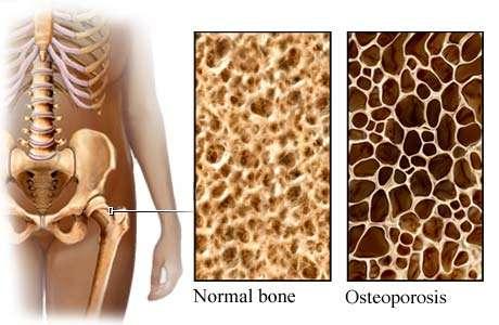 Bone health Osteoporosis is an