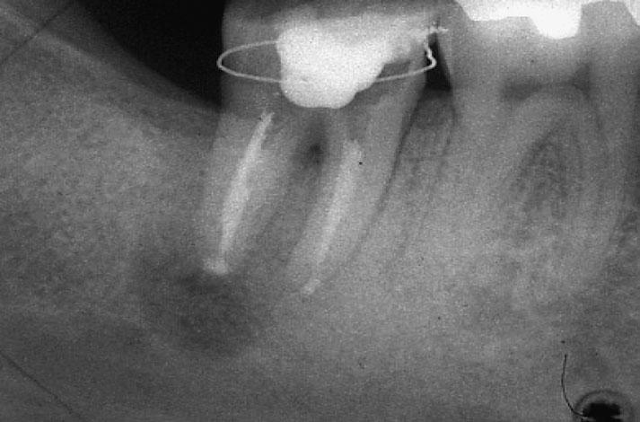 Throughout the procedure, periodontal ligament tissue was carefully treated without mechanical damage and drying. The enucleated tissue (Fig.