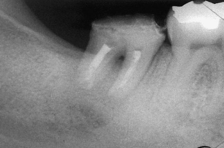 KCOTs comprise approximately 11% of all cysts of the jaws 8). They occur most commonly in the mandible, especially in the posterior body and ramus regions 1,12).