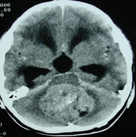 Spectrum of posterior fossa lesions in children: Cerebellar abscess- 3(27.2%), cerebellar astrocytoma- 2(18.1%), brainstem glioma- 2(18.1%), medulloblastoma- 2(18.