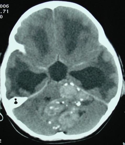 The commonest site of posterior fossa lesions was cerebellum (40%) in both children and adults. The cerebellum was involved in 4(36.3%) cases out of total 11 cases in children and in 8(42.