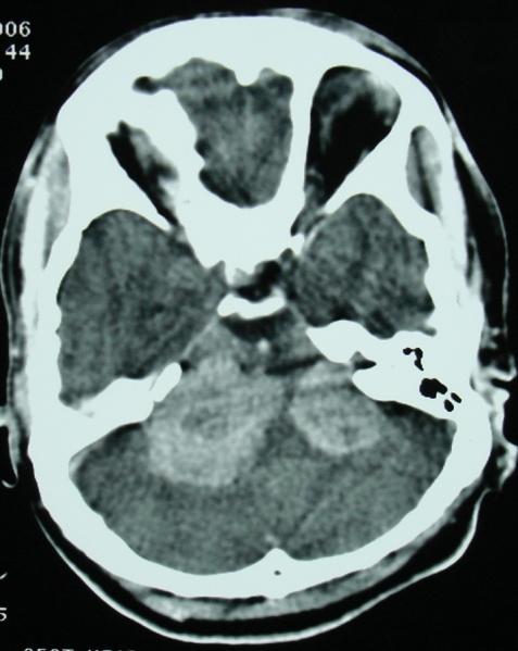 brainstem gliomas are two most common primary intraaxial neoplasms in adults. 4 Reider-Groswasser et al 5 found posterior fossa abnormalities in 190 of 7000 brain CT studies. Of these, 51.