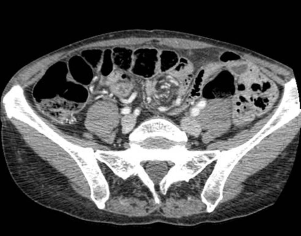 Fig. 8: Whirl sign: CT shows twisted and engorged