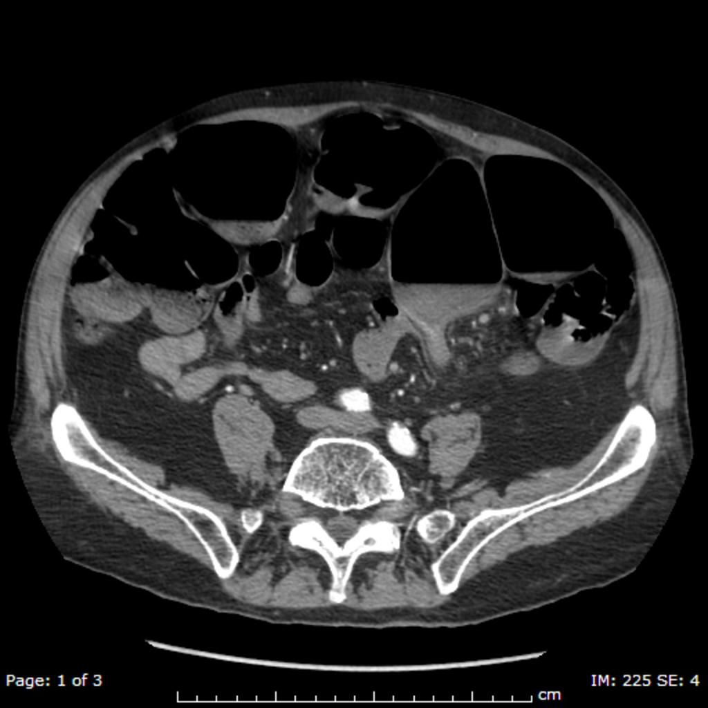 Fig. 11: CT scan shows