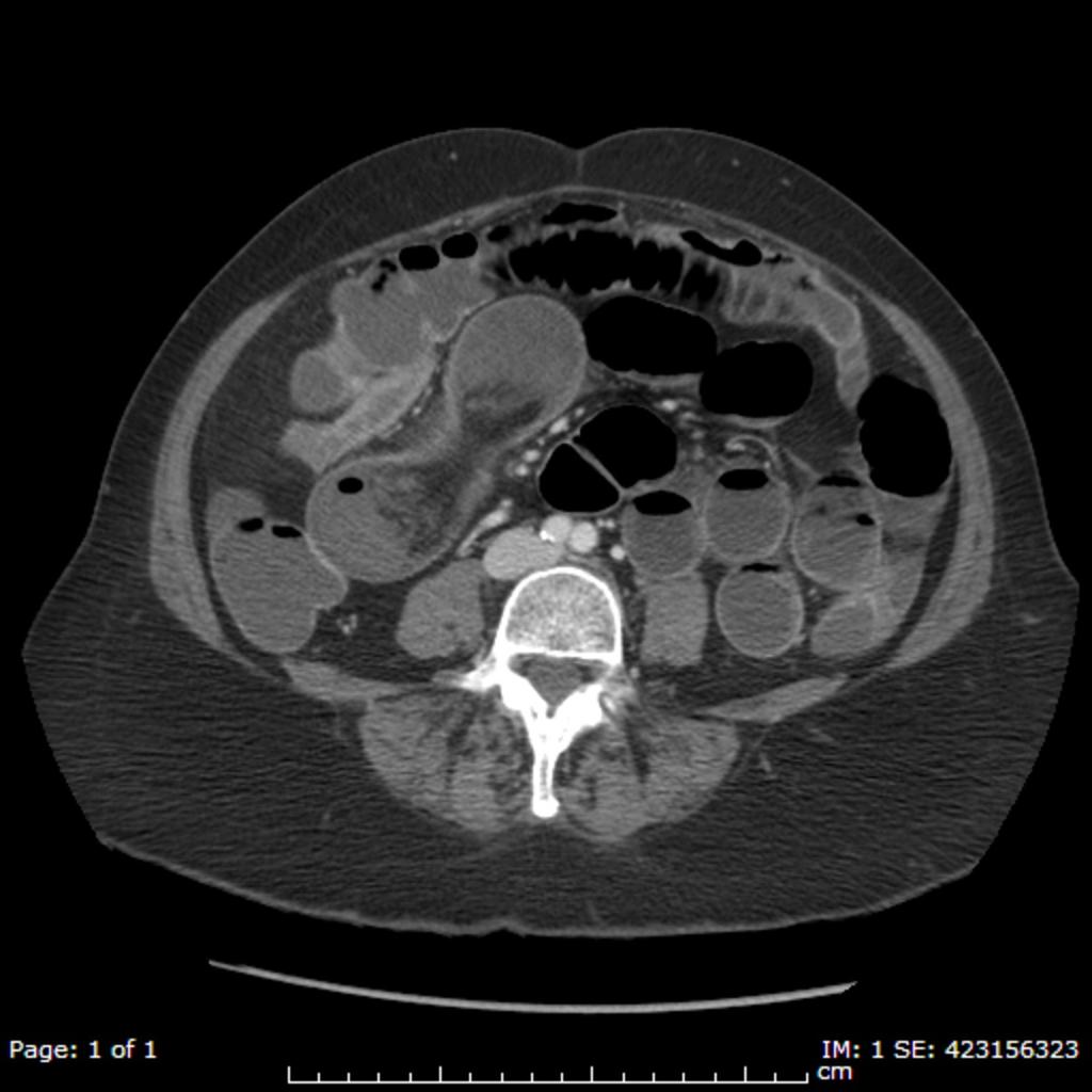 Fig. 14: CT scan shows small bowel obstruction