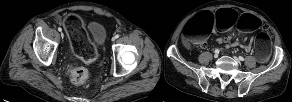 16: Large bowel obstruction caused by adenocarcinoma of the sigma-rectum.