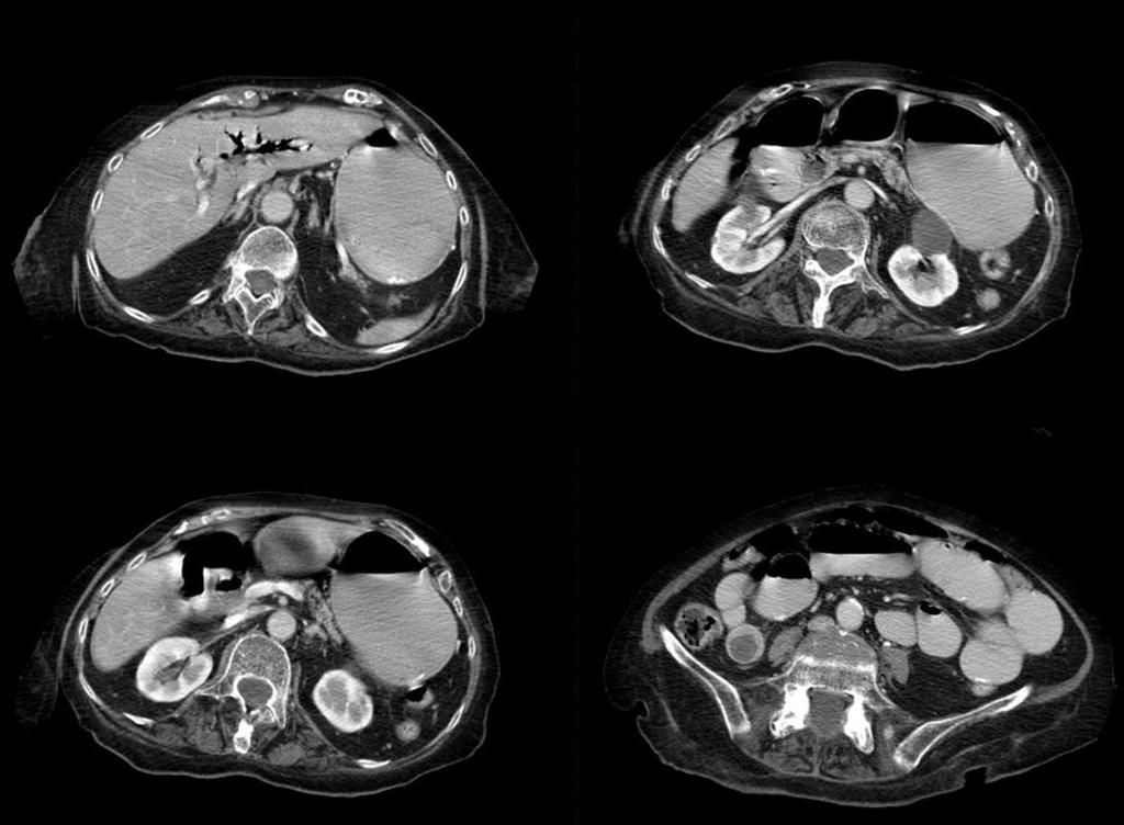 Fig. 17: Gallstone ileus. Abdominal CT scan demonstrates dilated proximal bowel and a gallstone at the distal ileum.